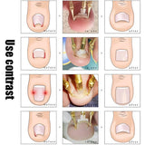 Toenail Reshaper(1SET)